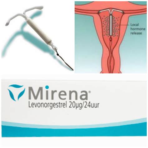 Laag libido door Mirena spiraal, ‘gebrek’ aan hormonen of…